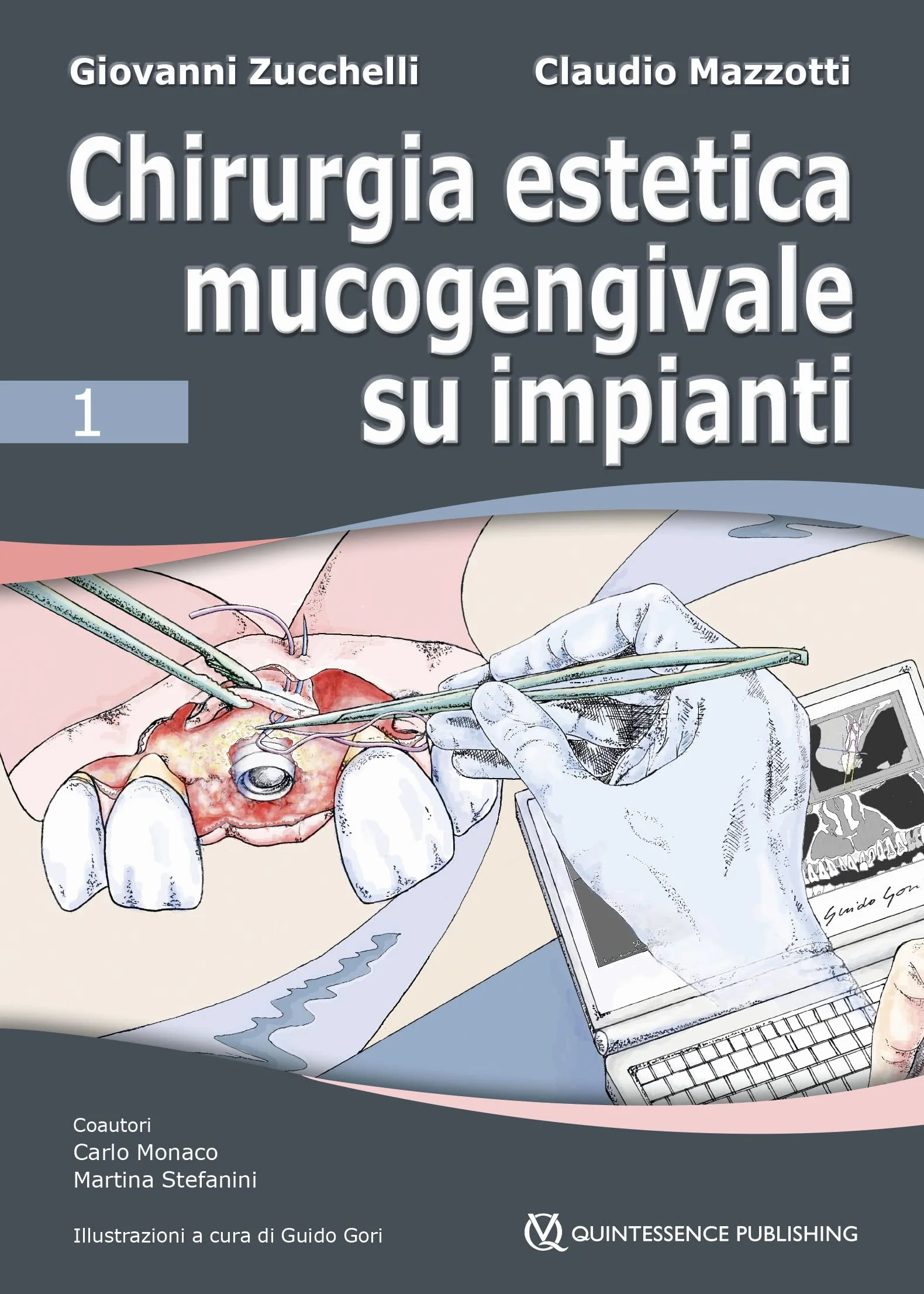 Chirurgia estetica mucogengivale su impianti