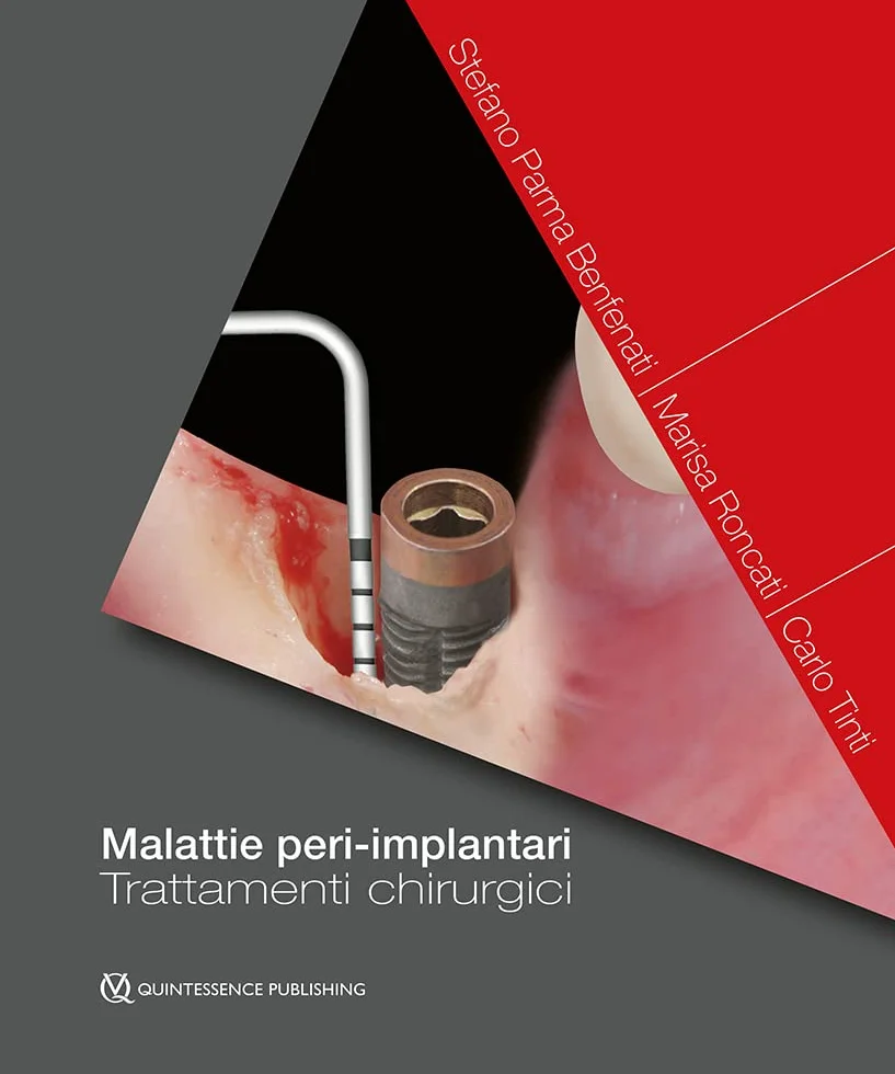 Malattie peri-implantari. Trattamenti chirurgici