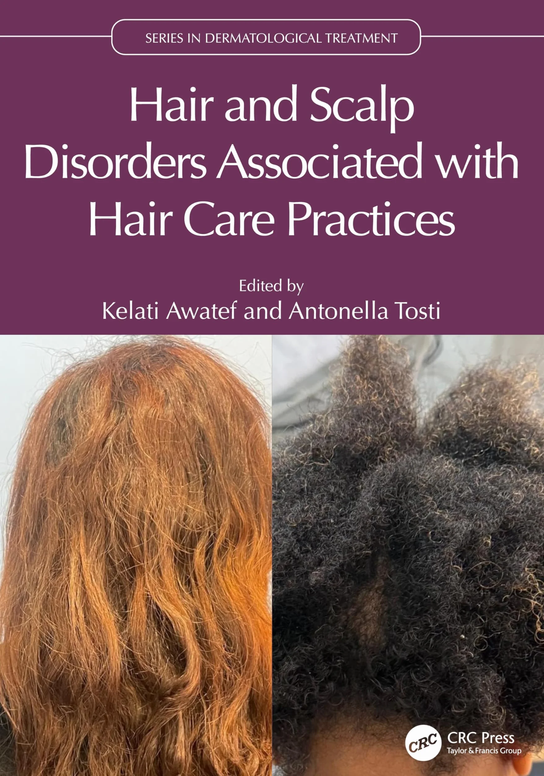 Hair and Scalp Disorders Associated with Hair Care Practices
