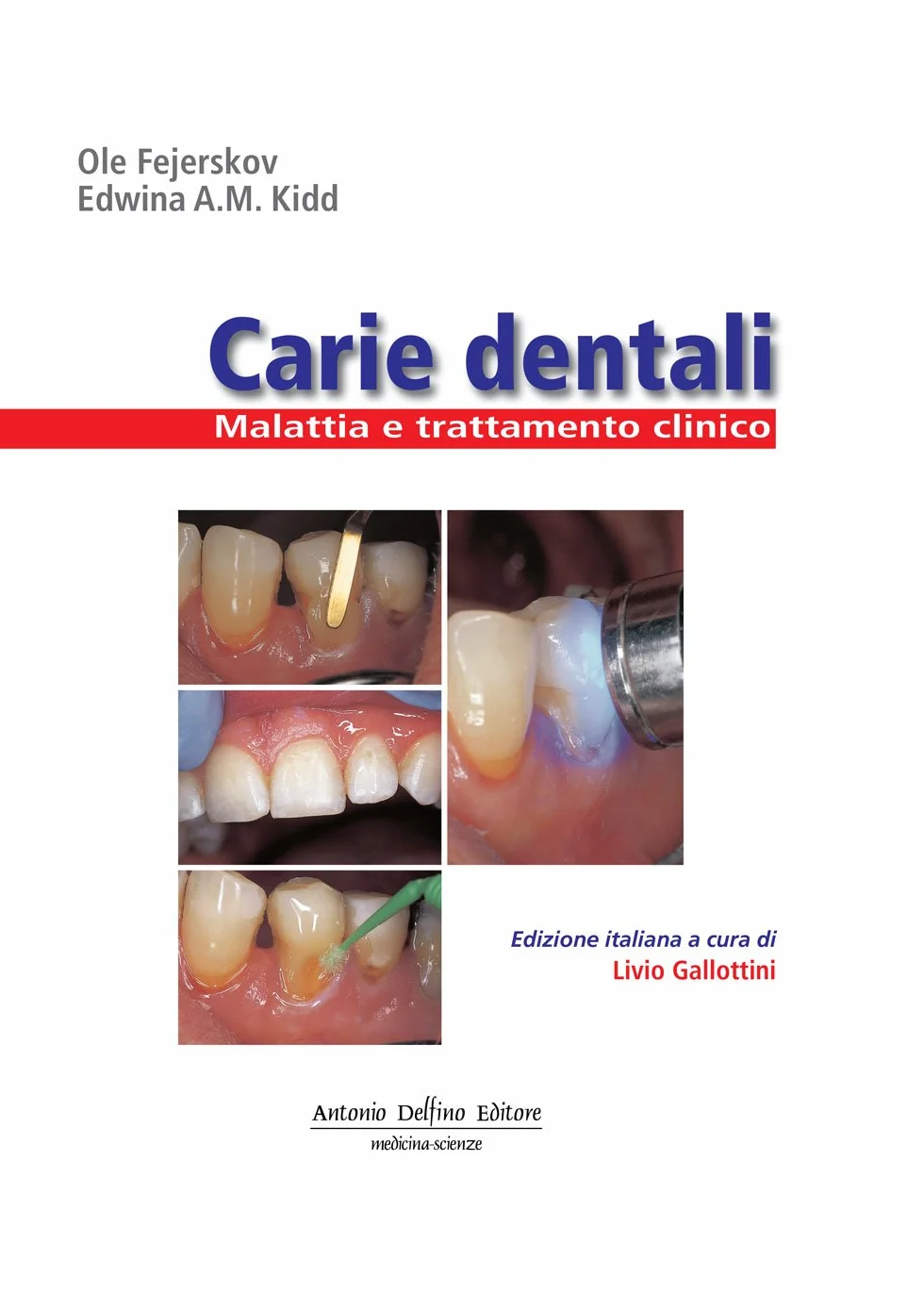 Carie dentali. Malattia e trattamento clinico. Ediz. illustrata