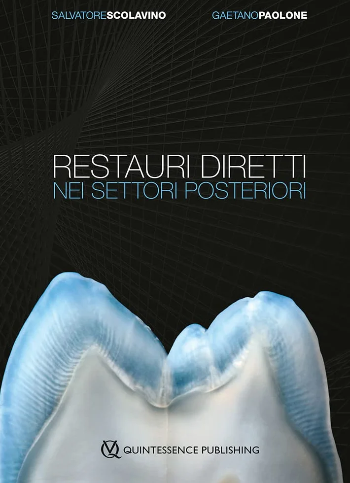 Restauri diretti nei settori posteriori